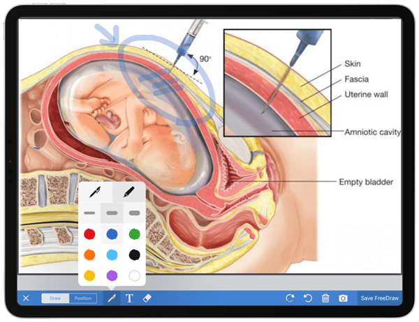 OBGYN Freedraw iPad