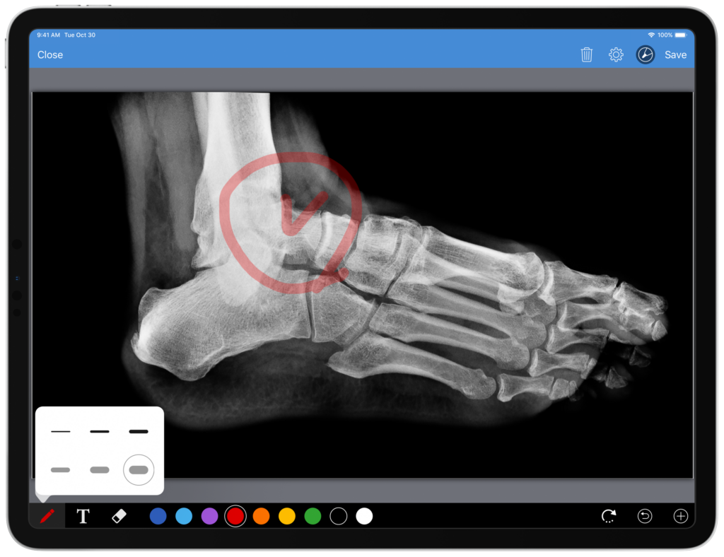 Choosing the Right Podiatry EHR Software for Your Practice A screenshot of the DrChrono EHR platform on an iPad screen. The screenshot displays an x-ray image of a foot, with a menu of digital drawing tools. The image has medical diagramming on it, presumably from said digital drawing tools.